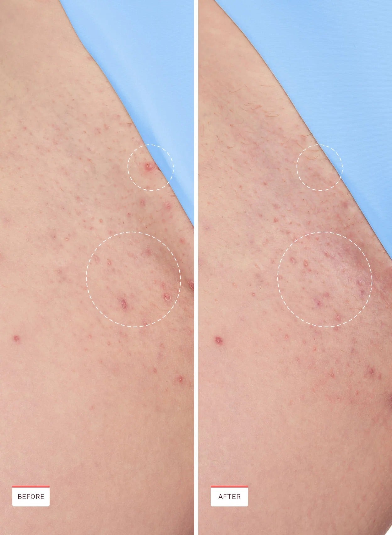 Lume Smoothing Solution